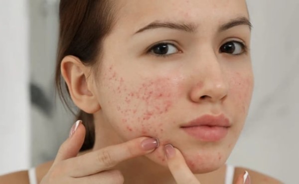 Có nên điều trị mụn tại các cơ sở giá rẻ