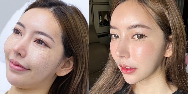 Lý do nên thực hiện HYDRAGLOW tại Citrine Derma Clinic
