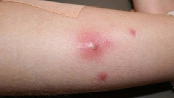 Mụn nhọt có thể gây ra biến chứng như thế nào