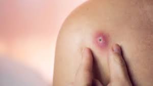 Nguyên nhân gây mụn nhọt là gì