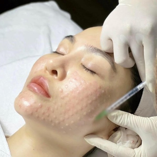 Tiêm meso là gì và cơ chế tác động lên da như thế nào