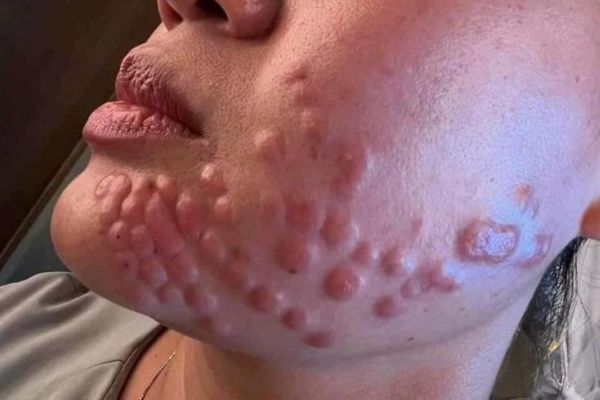 Tiêm meso sai kỹ thuật có thể gây nhiễm trùng, hoại tử và biến chứng nặng