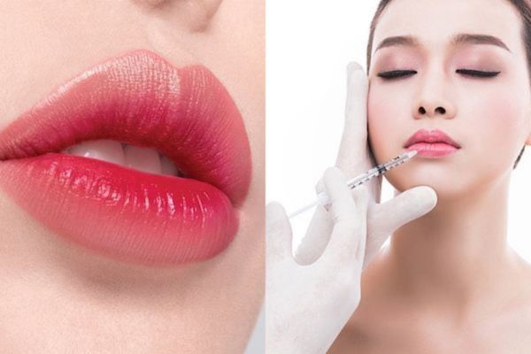 Dáng môi tiêm filler đẹp là dáng hài hòa khuôn mặt và tôn lên nét riêng