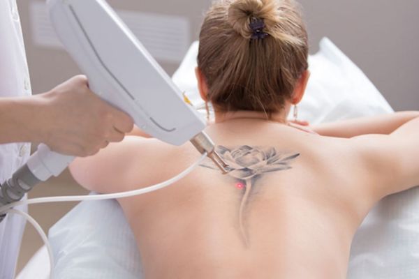 Xóa xăm laser dùng tia đặc hiệu phá vỡ mực, giúp cơ thể đào thải an toàn