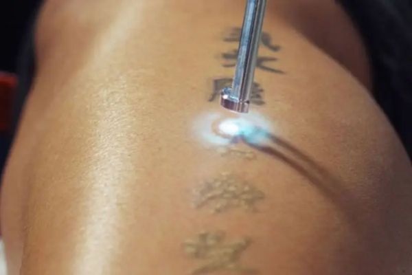 Chi phí xóa xăm phụ thuộc diện tích, màu mực, công nghệ và số buổi điều trị