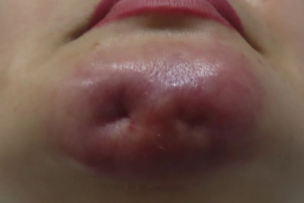 Đau dữ dội, tím tái hay sưng sốt sau tiêm cần gặp bác sĩ ngay