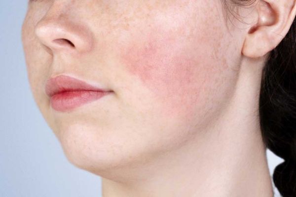 Liên hệ bác sĩ ngay nếu có dấu hiệu bất thường sau HIFU