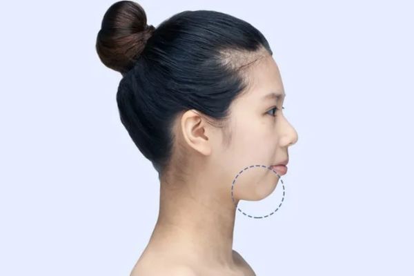 Filler cằm giúp cải thiện dáng cằm nhanh, không cần phẫu thuật