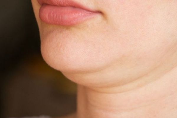 Nọng cằm khiến gương mặt kém thon gọn và trông già hơn