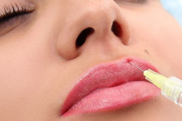 Quy trình tiêm filler môi diễn ra 15–30 phút với 4 bước an toàn, chuẩn y khoa