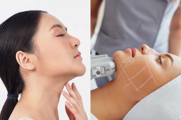 Mỗi cách xóa nọng cằm phù hợp với mức độ và nhu cầu khác nhau