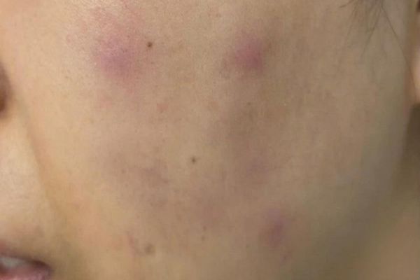 Tiêm meso có thể gây sưng đỏ, bầm nhẹ nhưng thường tự hết sau vài ngày