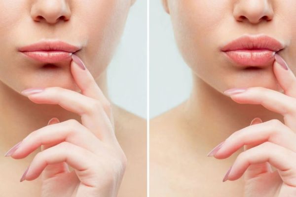 Tiêm filler môi thường vào form sau 7–10 ngày, tùy cơ địa từng người