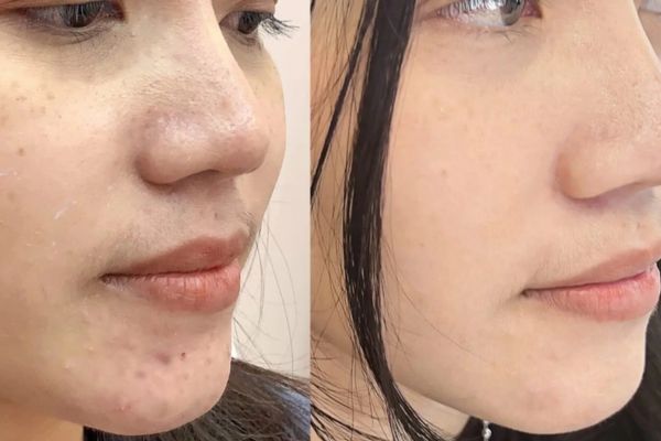 Tiêm meso đa công dụng phục hồi căng bóng trị mụn trắng da trẻ hóa