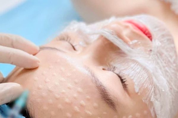 Hiệu quả tiêm meso phụ thuộc kỹ thuật hoạt chất và tay nghề bác sĩ thực hiện