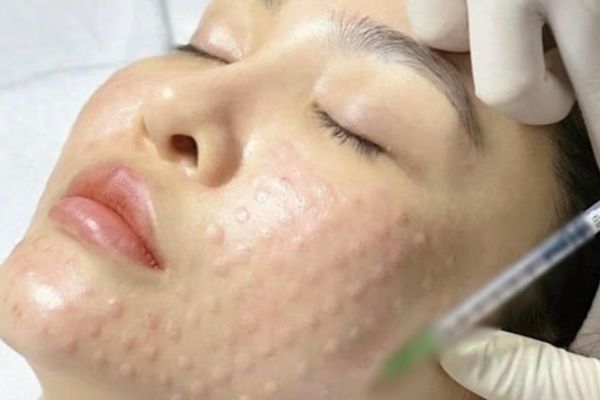 Tiêm meso đưa dưỡng chất vào trung bì, giúp da phục hồi và sáng khỏe