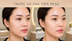 Trước và sau tiêm Meso