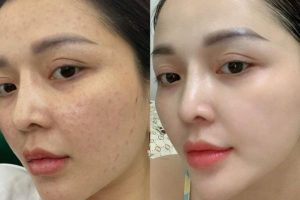 trước và sau tiêm meso