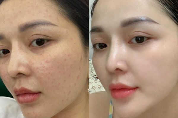 trước và sau tiêm meso