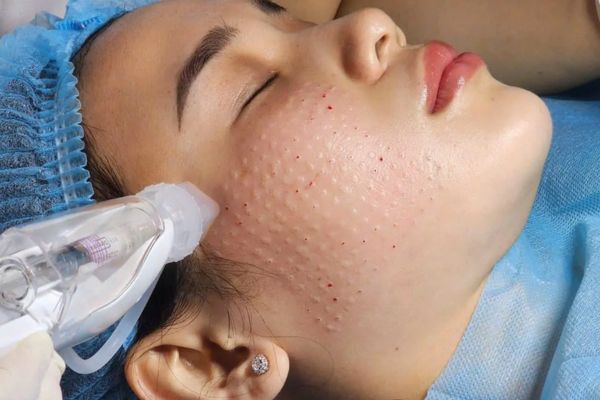 Mesotherapy tạo vi tổn thương kích thích tái tạo và tăng sinh collagen