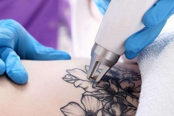 Xóa xăm là quá trình phá vỡ mực xăm để cơ thể tự đào thải