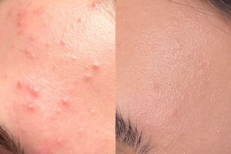 6 mẹo trị mụn ẩn tại nhà đem lại hiệu quả tối ưu