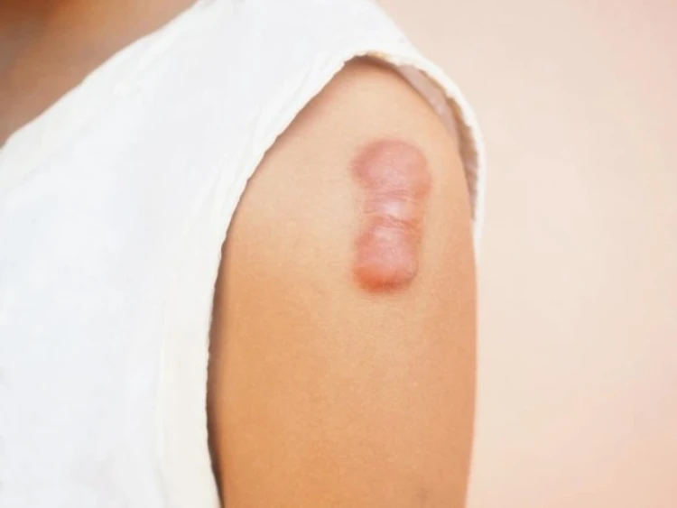 Cùng tìm hiểu các cách trị sẹo lồi hiệu quả hiện nay
