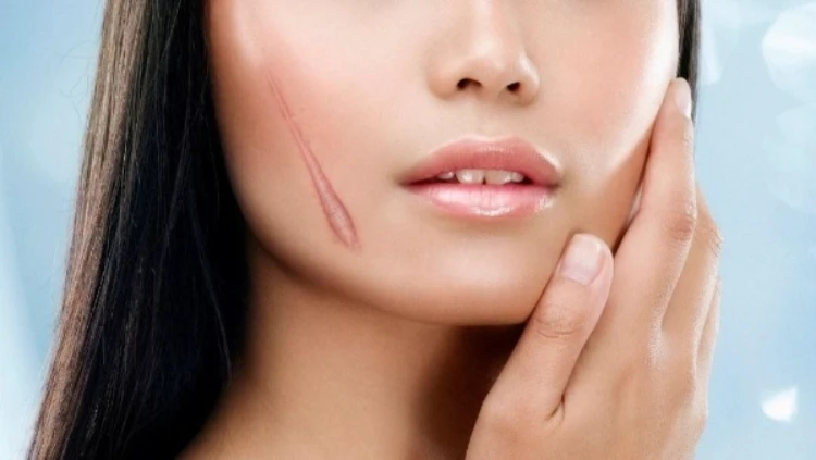 Dấu hiệu nhận biết biến chứng sau khi tiêm sẹo lồi