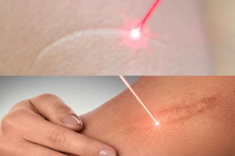 Điều trị sẹo lồi bằng phương pháp laser