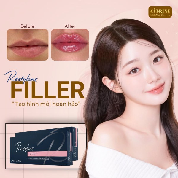 Filler môi