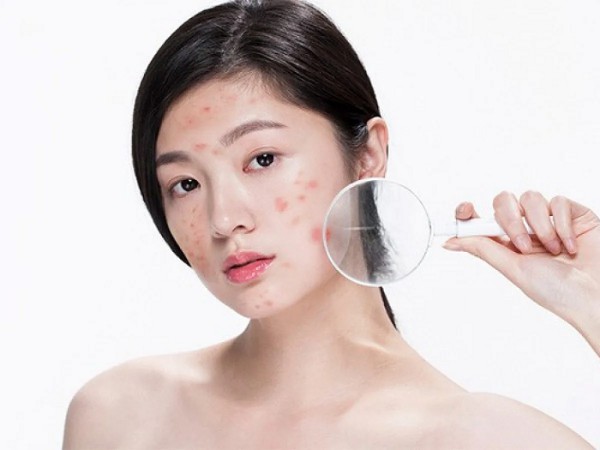Làm sao để hết mụn