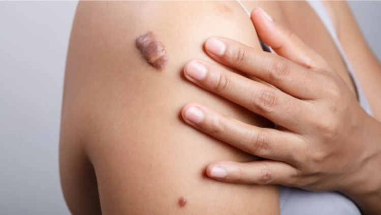 Lý do vì sao sẹo lồi thường bị ngứa nguyên nhân do đâu