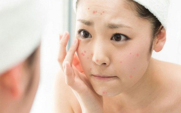 Nguyên nhân gây nên tình trạng mụn ẩn và mụn tuổi dậy thì 