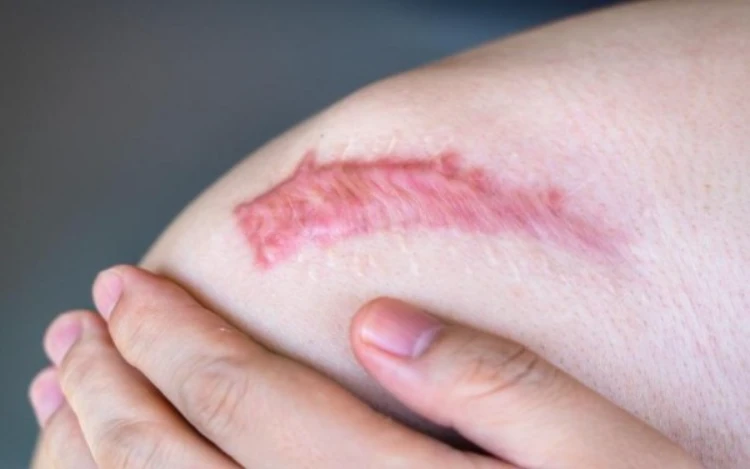 Những phương pháp nào tiềm ẩn nguy cơ biến chứng sau khi tiêm sẹo lồi