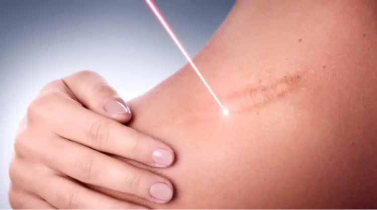 Phương pháp thẩm mỹ sử dụng tia laser
