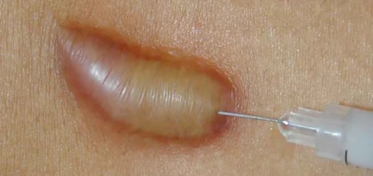Thời gian xẹp sẹo với từng loại sẹo là bao lâu