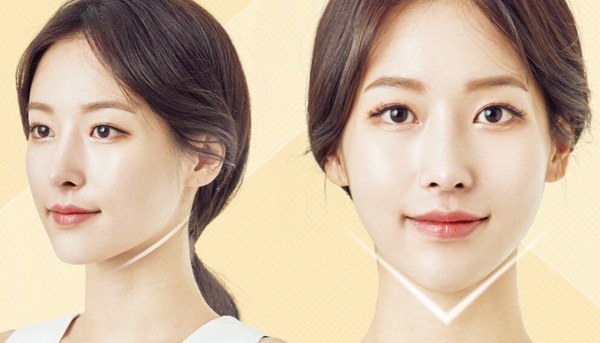 Tiêm filler cằm