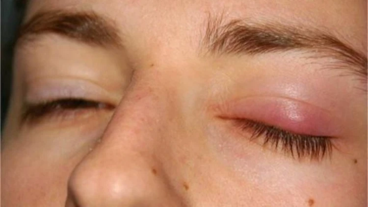 Tình trạng sụp mí sau tiêm botox