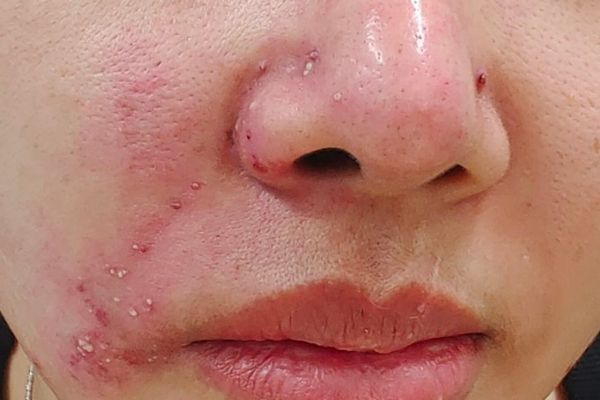 Không tiêm filler mũi nếu rối loạn đông máu, dị ứng hoặc đang viêm nhiễm