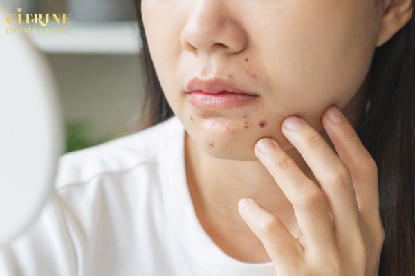 Hormone tăng cao kích thích dầu nhờn gây mụn ở cằm theo chu kỳ