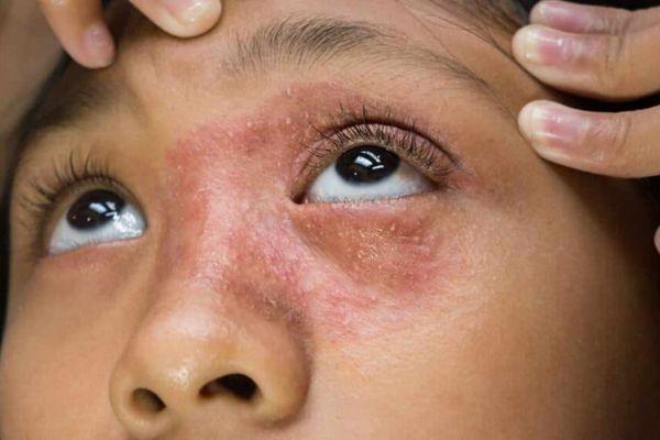Quy trình da phục hồi trở lại trong 7 ngày vàng sau laser