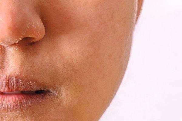 Yếu tố nào tác động tới khả năng bình phục của da bong vảy?