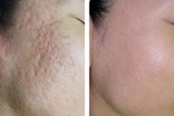Citrine phối hợp nhiều phác đồ điều trị sẹo để nâng cao hiệu quả