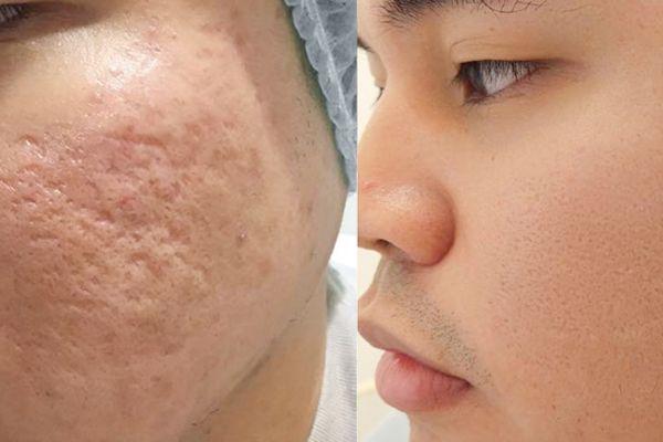 Chi phí điều trị sẹo sau laser và hiệu quả thăm khám