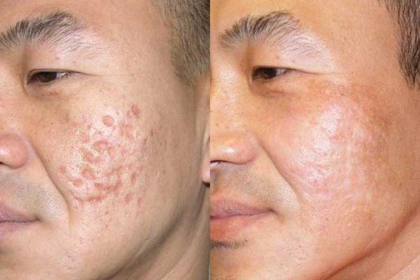 Bắn Laser Trị Sẹo Có Tốt Không? Những Điều Cần Biết