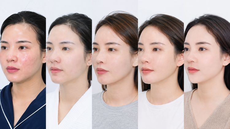 Bao lâu thì thấy thay đổi sau tiêm Botox gọn hàm