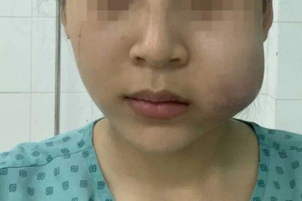 Filler làm đầy rãnh cười giúp gương mặt trẻ trung nhanh chóng
