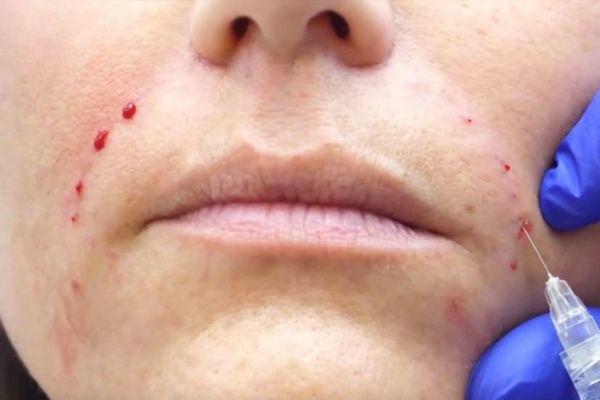 Filler bị tràn lên má do sai sót về kỹ thuật tiêm