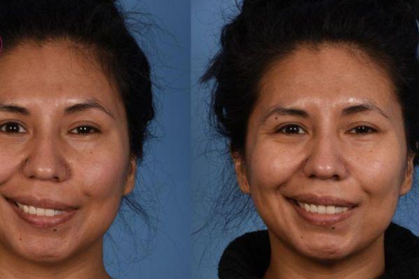 Chăm sóc đúng cách giúp filler ổn định và bền đẹp lâu