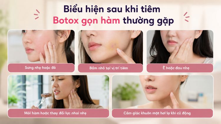 Biểu hiện sau khi tiêm Botox gọn hàm thường gặp
